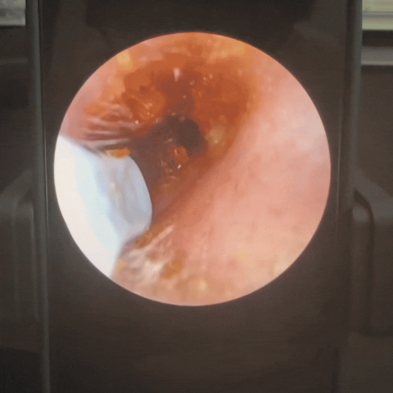 Smart Öronrengöring med inbyggd kristallklart och enastående hygien med vår smarta öronrengöring. Utrustad med en högupplöst kamera och Bluetooth, den här enheten låter dig se och rengöra dina öron säkert. Perfekt för hela familjen!